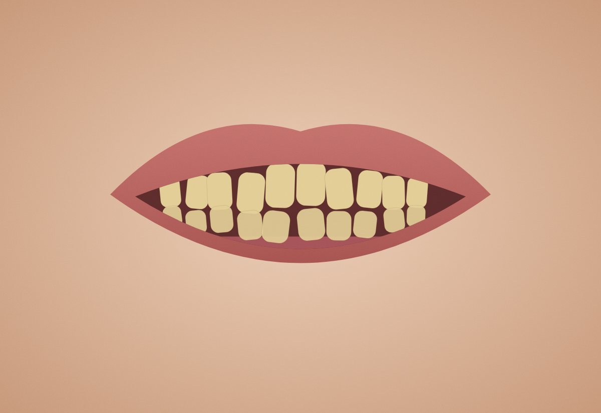 Before – Diastema kapatma