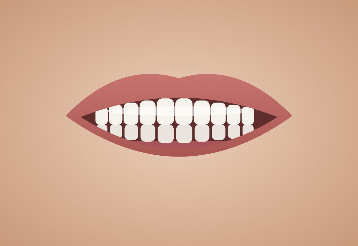 After – Diastema kapatma